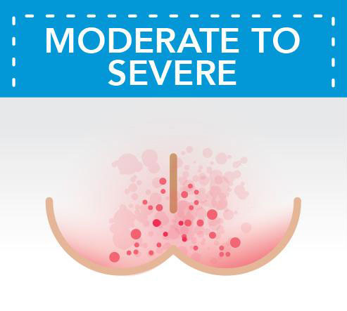 moderate to severe diaper rash on bottom